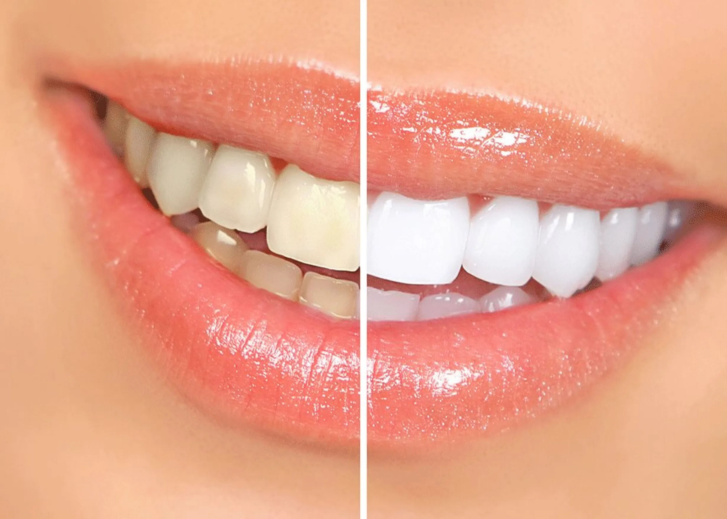 Teeth Whitening Course Cost