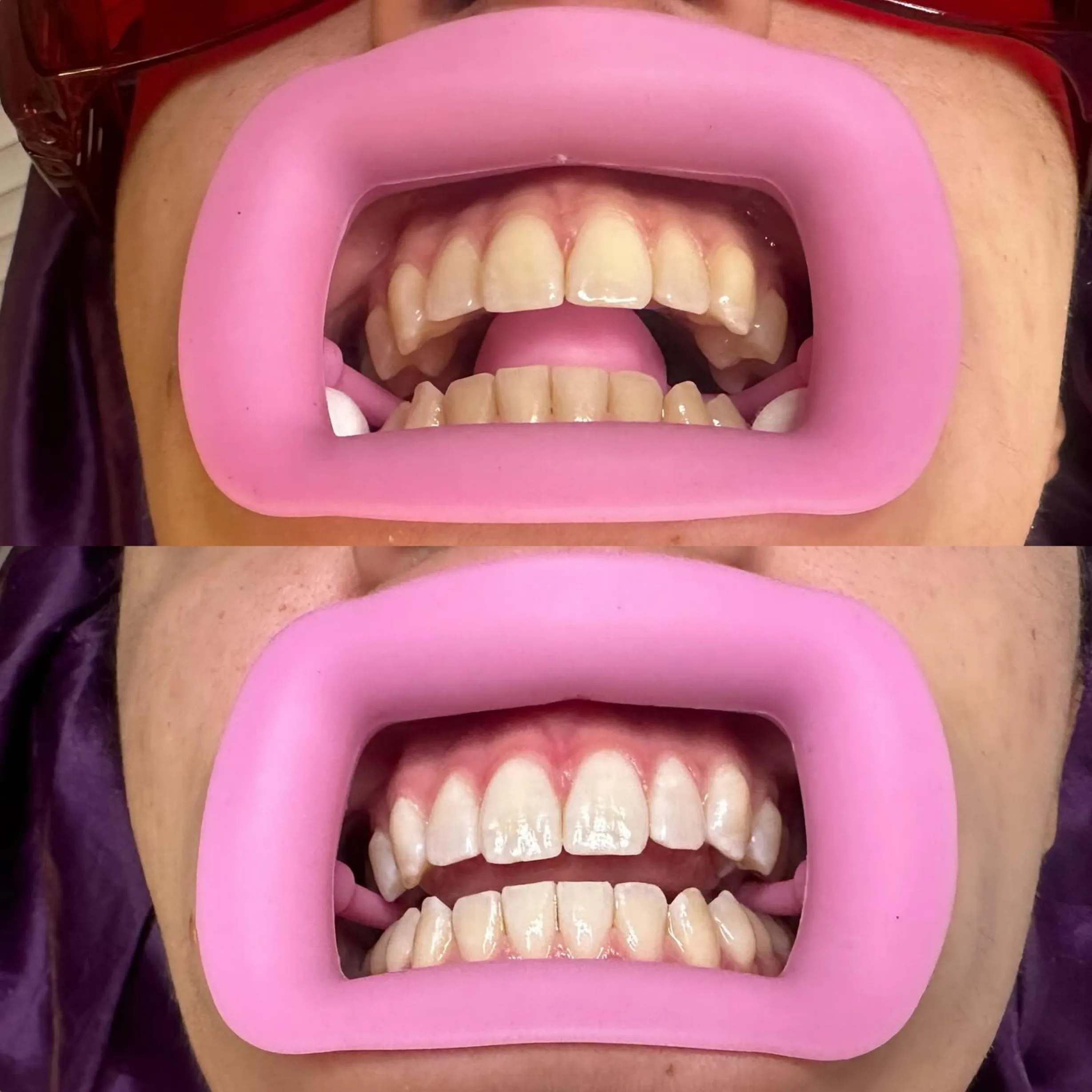 affordable teeth whitening courses