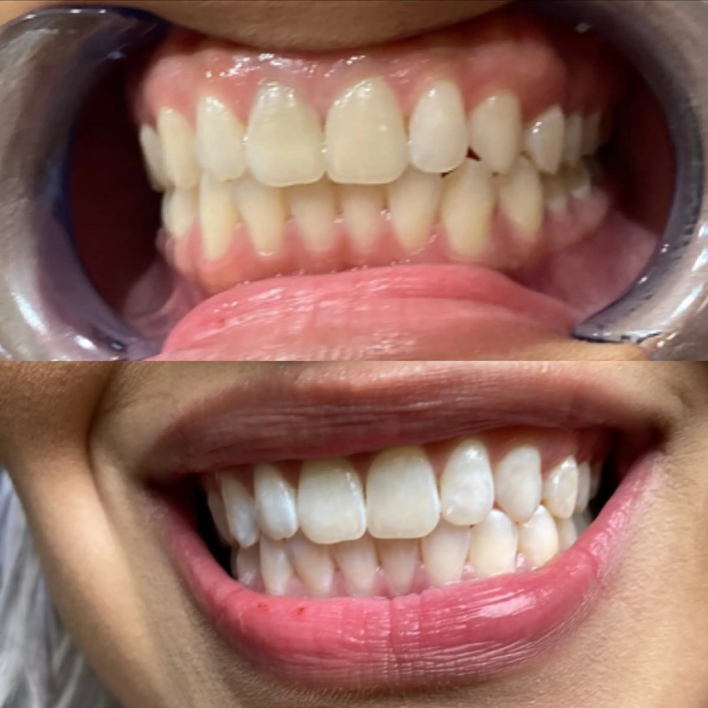 certified teeth whitening course cost