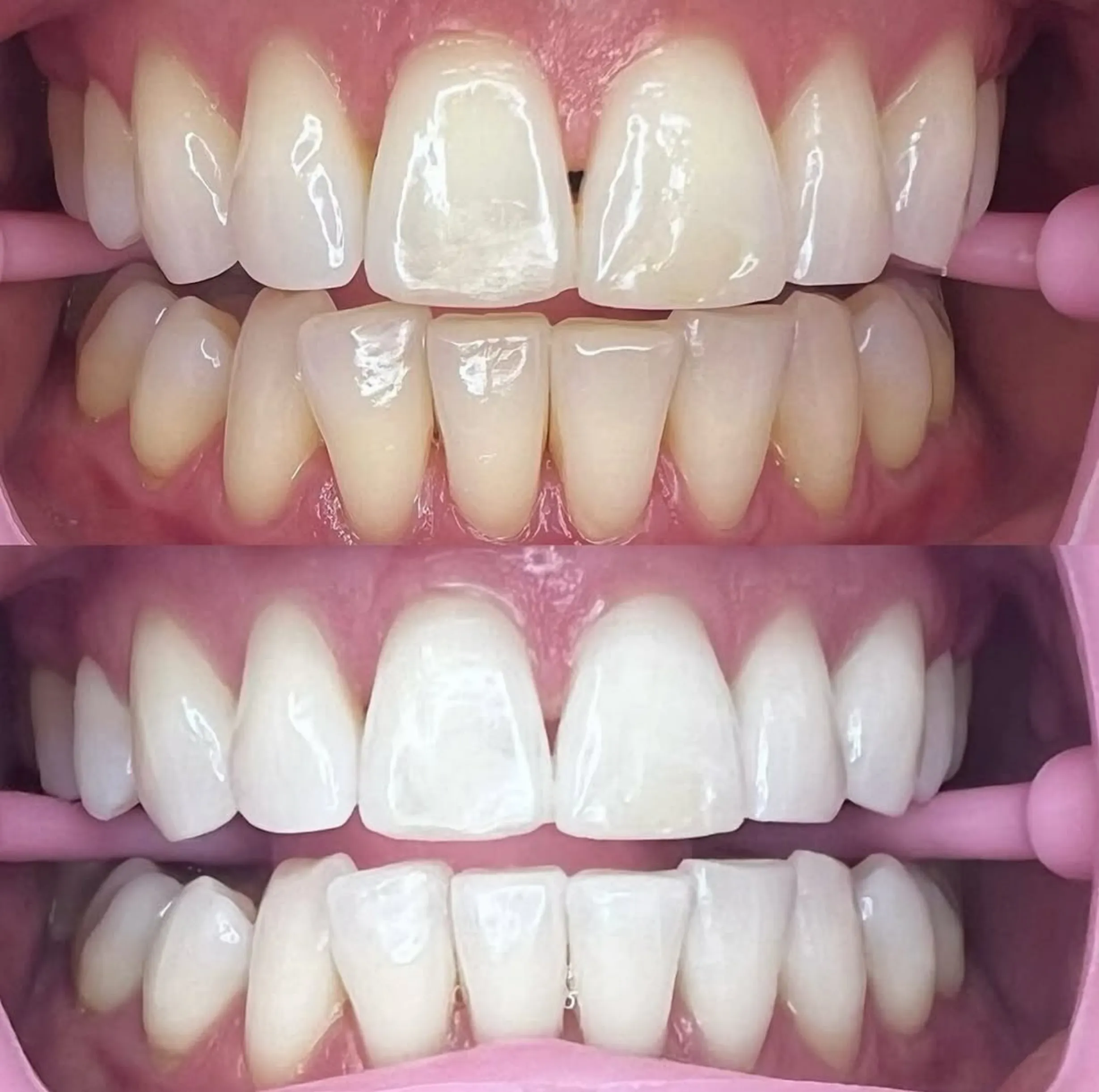 online vs in-person teeth whitening course