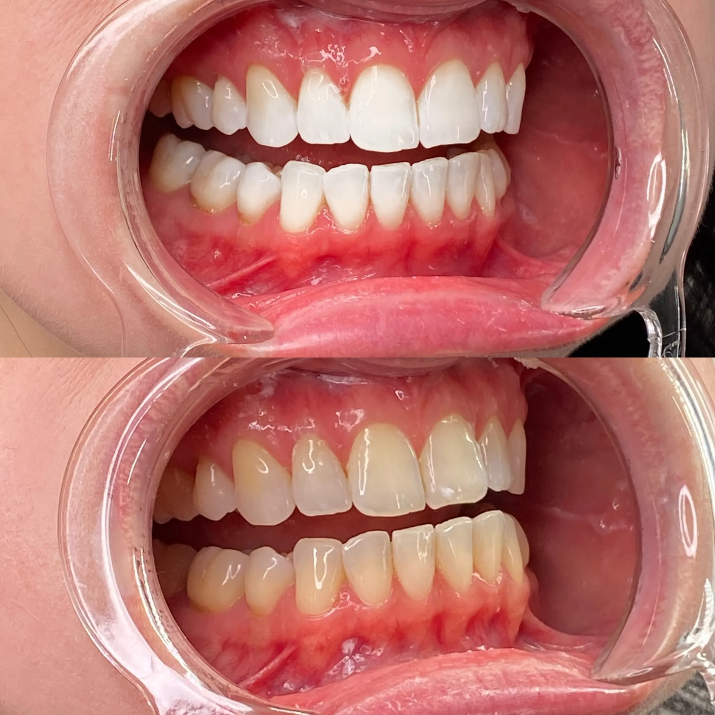 teeth whitening training with kit